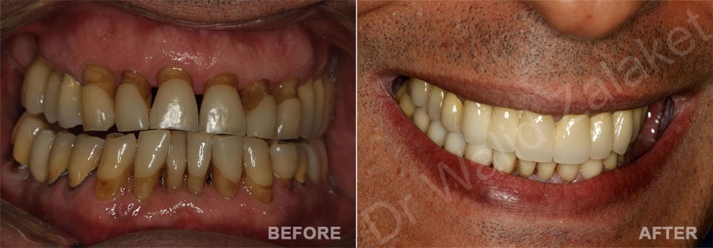 restorative dentistry lebanon